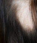 Alopecia Areata Awareness Month