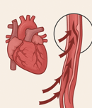 aortic dissection awareness day