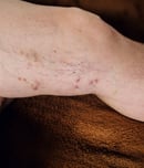 deep vein trombosis (dvt) awareness month