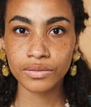 international skin pigmentation day