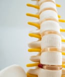 Lumbar spine displaced herniated disc fragment, spinal nerve and bone. Model for treatment medical in the orthopedic department.