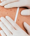 melanoma monday