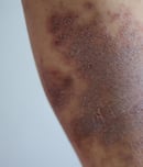 national amyloidosis