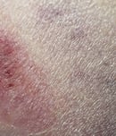 necrotizing fasciitis awareness day