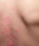 Psoriasis Vulgaris, skin patches are typically red, itchy, and scaly. Papules of chronic psoriasis vulgaris on male hand, back and body. Genetic immune disease. Detail of psoriatic skin disease