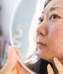 rosacea awareness month