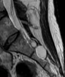 tarlov cyst disease