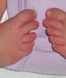 world clubfoot day