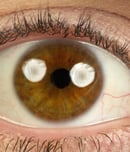 world keratoconus day