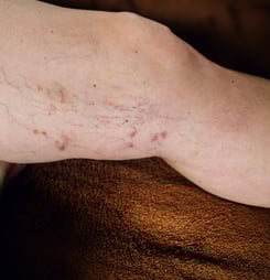 deep vein trombosis (dvt) awareness month