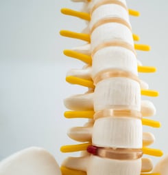 Lumbar spine displaced herniated disc fragment, spinal nerve and bone. Model for treatment medical in the orthopedic department.
