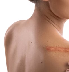 scar appreciation day