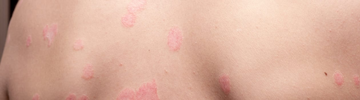 Psoriasis Vulgaris, skin patches are typically red, itchy, and scaly. Papules of chronic psoriasis vulgaris on male hand, back and body. Genetic immune disease. Detail of psoriatic skin disease