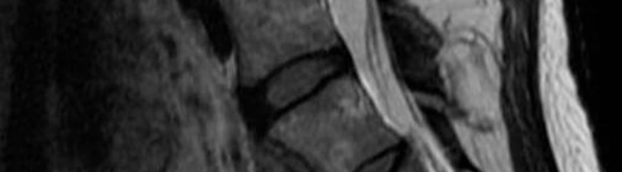 tarlov cyst disease