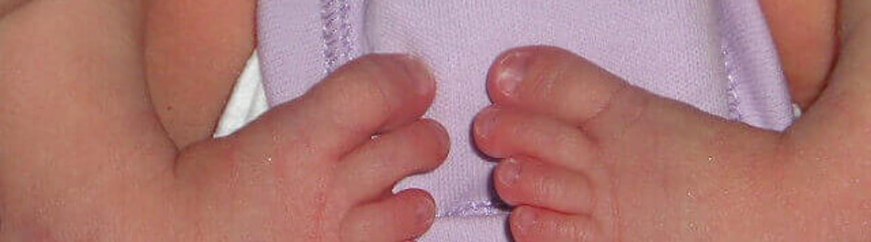 world clubfoot day