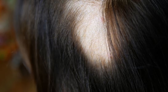 Alopecia Areata Awareness Month