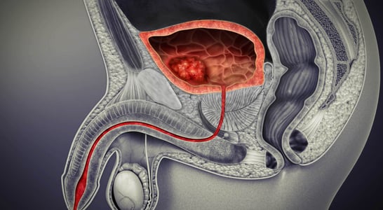 Bladder Cancer Awareness Day