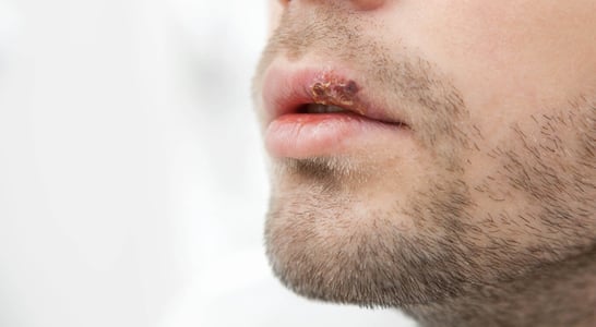 Herpes Awareness Day