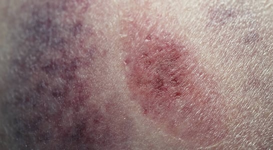 Necrotizing Fasciitis Awareness Day