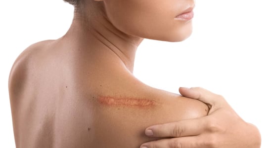 Scar Appreciation Day