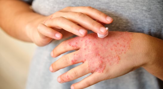 Eczema Awareness Month