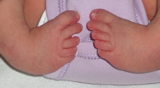 World Clubfoot Day