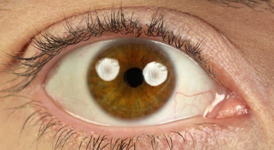 World Keratoconus Day