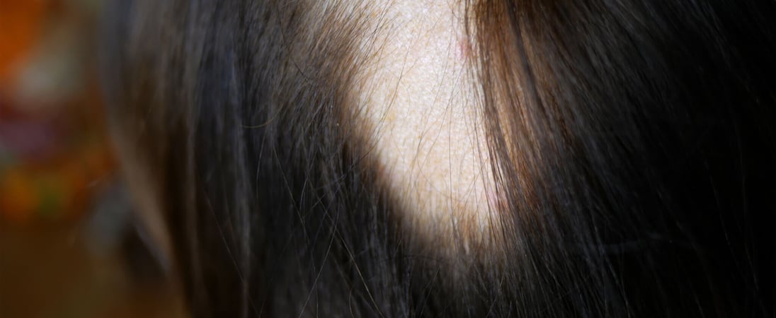 Alopecia Areata Awareness Month