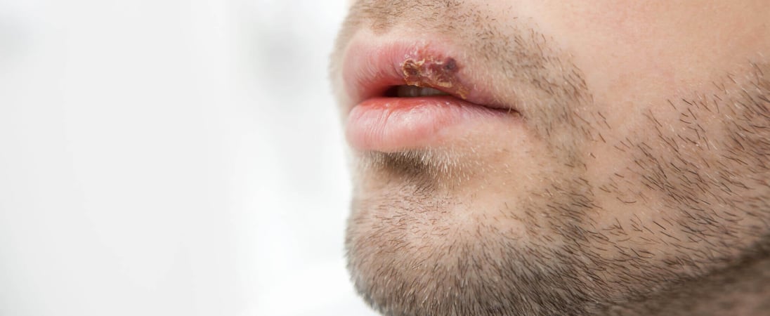 Herpes Awareness Day