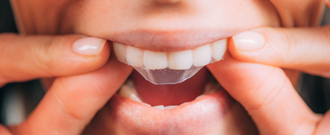 National Align Your Teeth Day