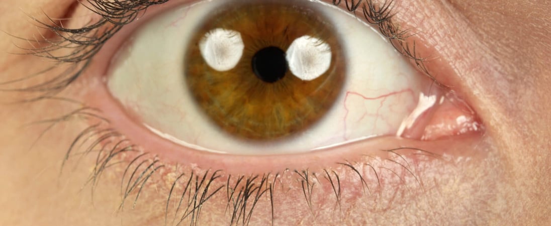 National Mechanical Dry Eye Day
