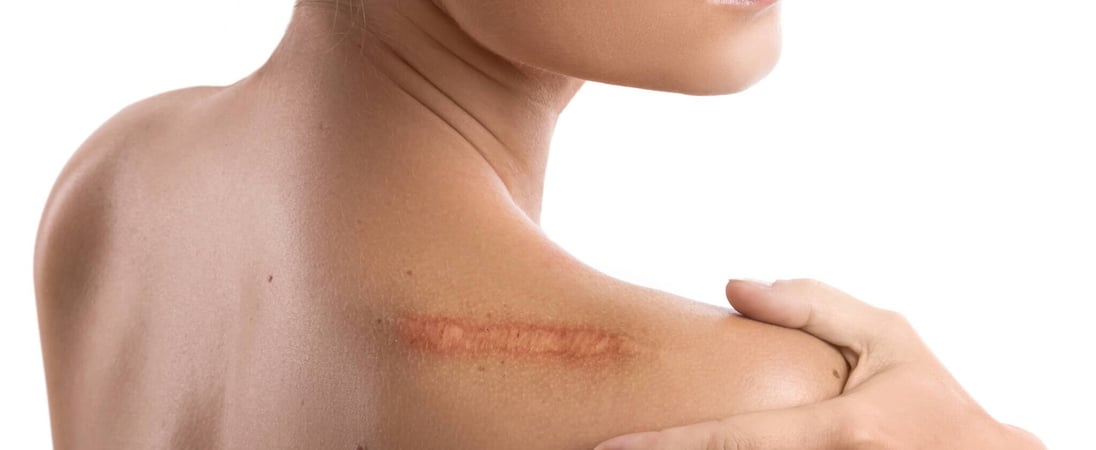 Scar Appreciation Day
