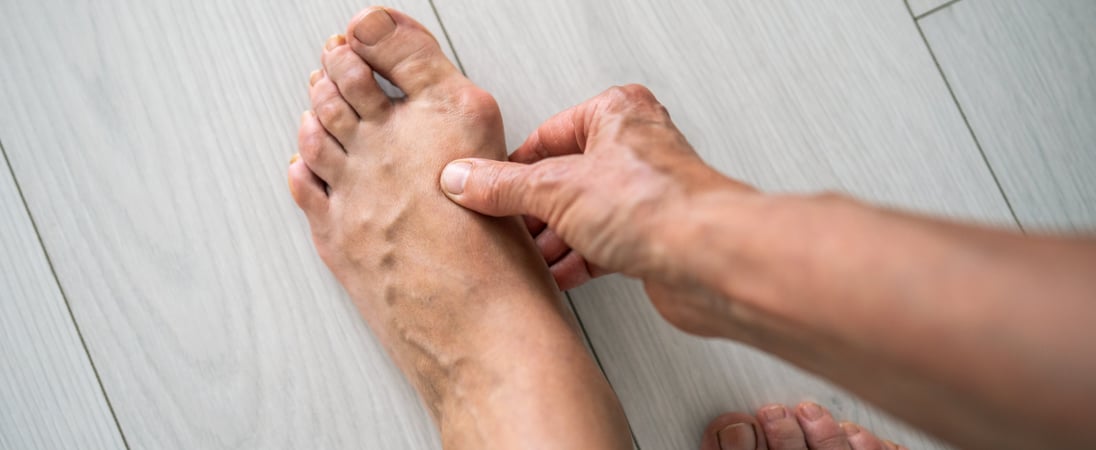 National Bunion Day