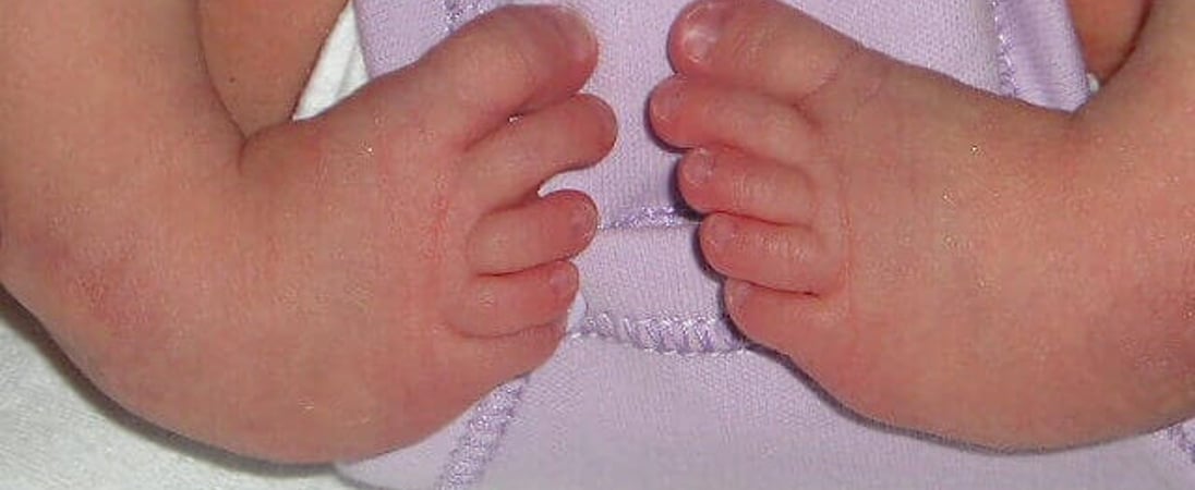 World Clubfoot Day