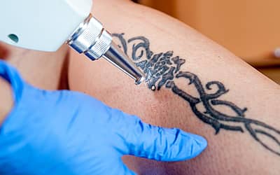 National Tattoo Removal Day
