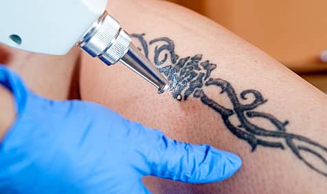 National Tattoo Removal Day