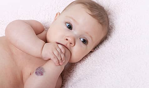 International Vascular Birthmarks Awareness Day