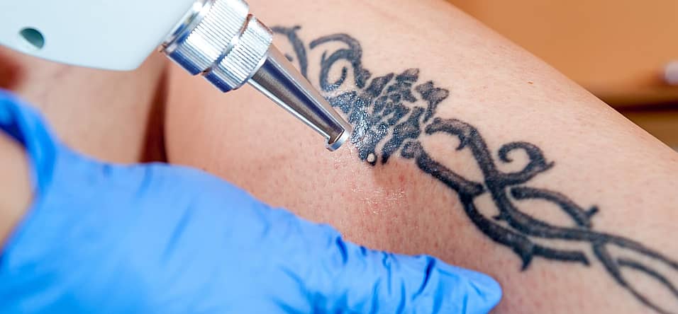 National Tattoo Removal Day