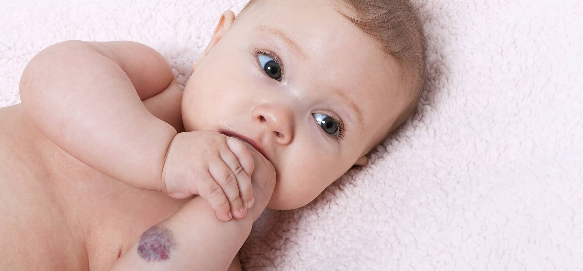 International Vascular Birthmarks Awareness Day (May 15th) Days Of