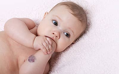 International Vascular Birthmarks Awareness Day
