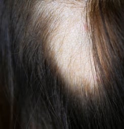 Alopecia Areata Awareness Month