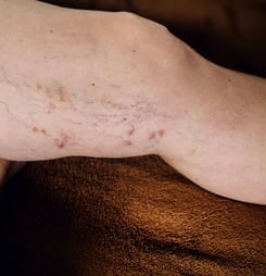 deep vein trombosis (dvt) awareness month