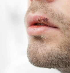 herpes awareness day