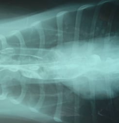 myasthenia gravis awareness