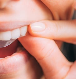 National Align Your Teeth Day