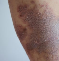 national amyloidosis