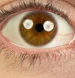 National Mechanical Dry Eye Day