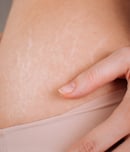 national stretch mark day