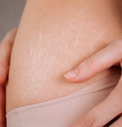 national stretch mark day