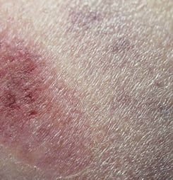 necrotizing fasciitis awareness day